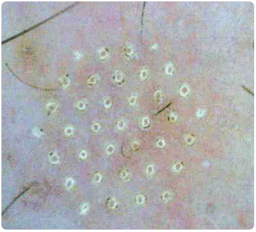 peau au microscope après rajeunissement fractionné