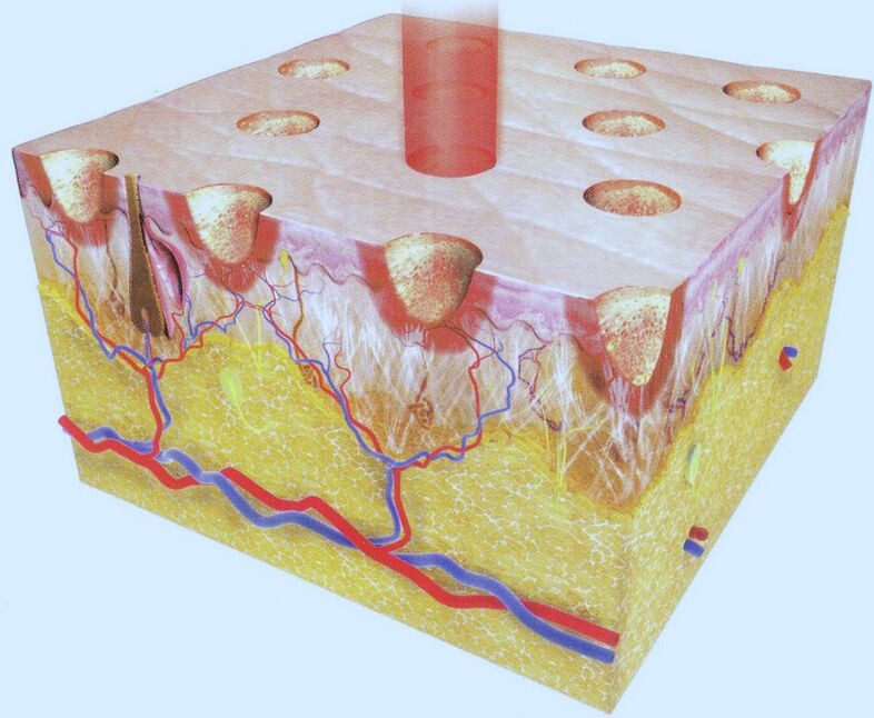 thermolyse laser fractionnée