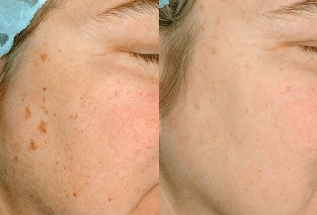 Élimination de la pigmentation sur la peau