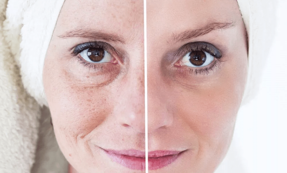 rajeunissement du visage au laser